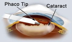 cataract 3.jpg